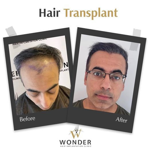 Wonder Hair Clinic | Best  FUE Hair Transplant in 