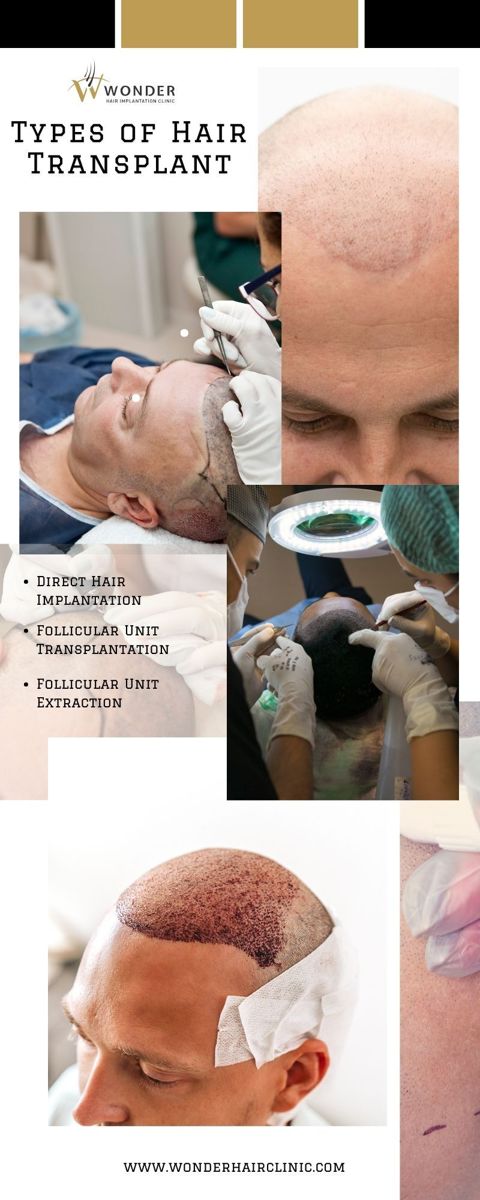 Types of Hair Transplant