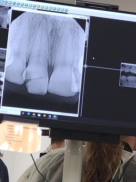 An X-Ray of the Tooth