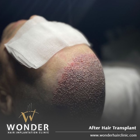 Revitalize Your Look with FUE Hair Transplant in I