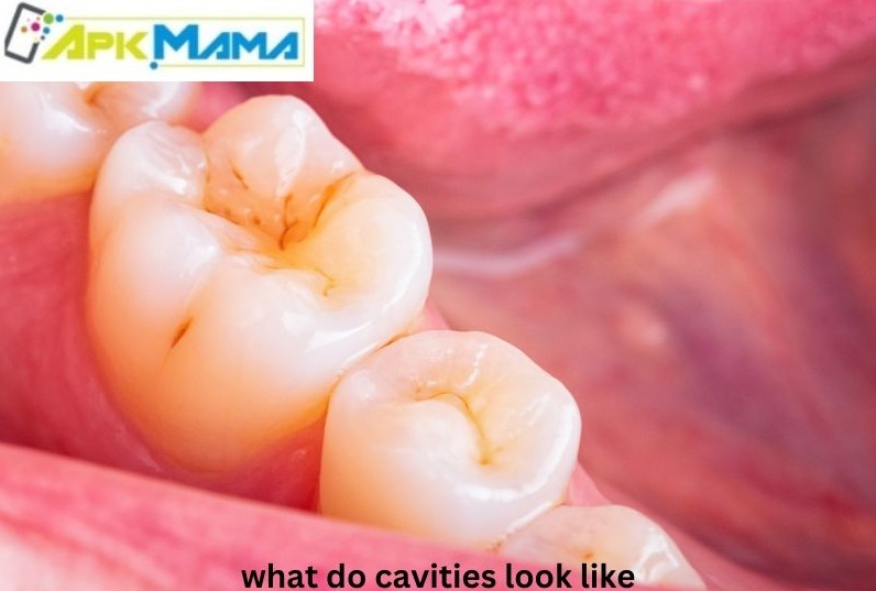 What Do Cavities Look Like?